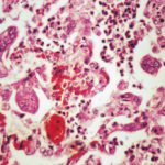 Simian measles pneumonia - Case 287