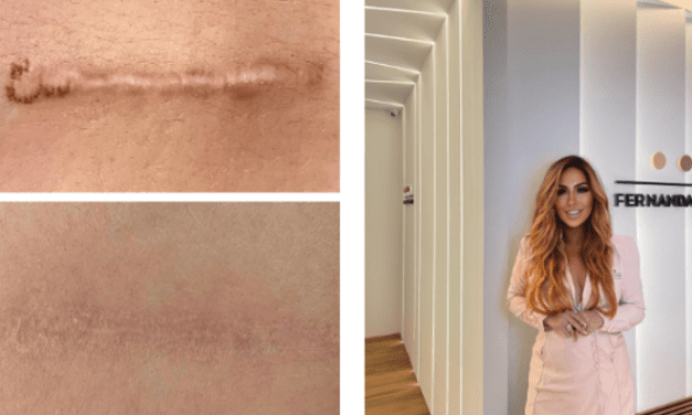 Husband gives wife a cesarean scars camouflage. Expert Fernanda Jaffre explains the technique